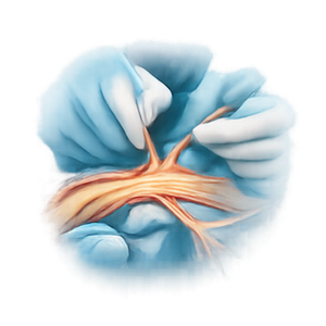 Peripheral Nerve Surgery
